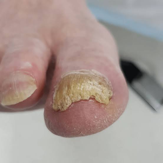 Fungal nail and foot care photo