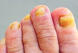 Fungal nail and foot care photo