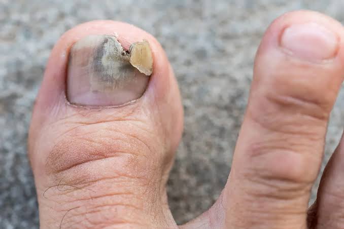 Fungal nail and foot care photo