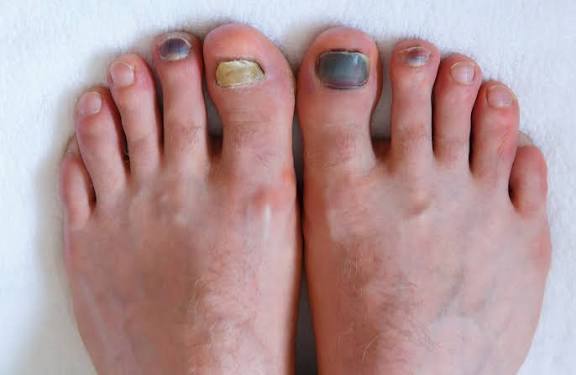 Fungal nail and foot care photo