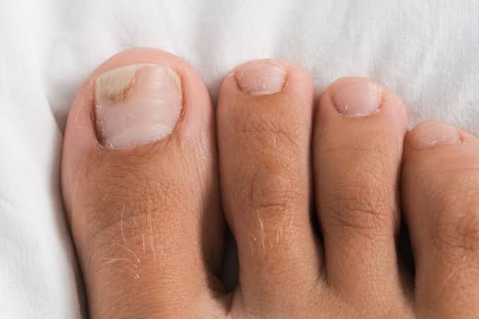Fungal nail and foot care photo