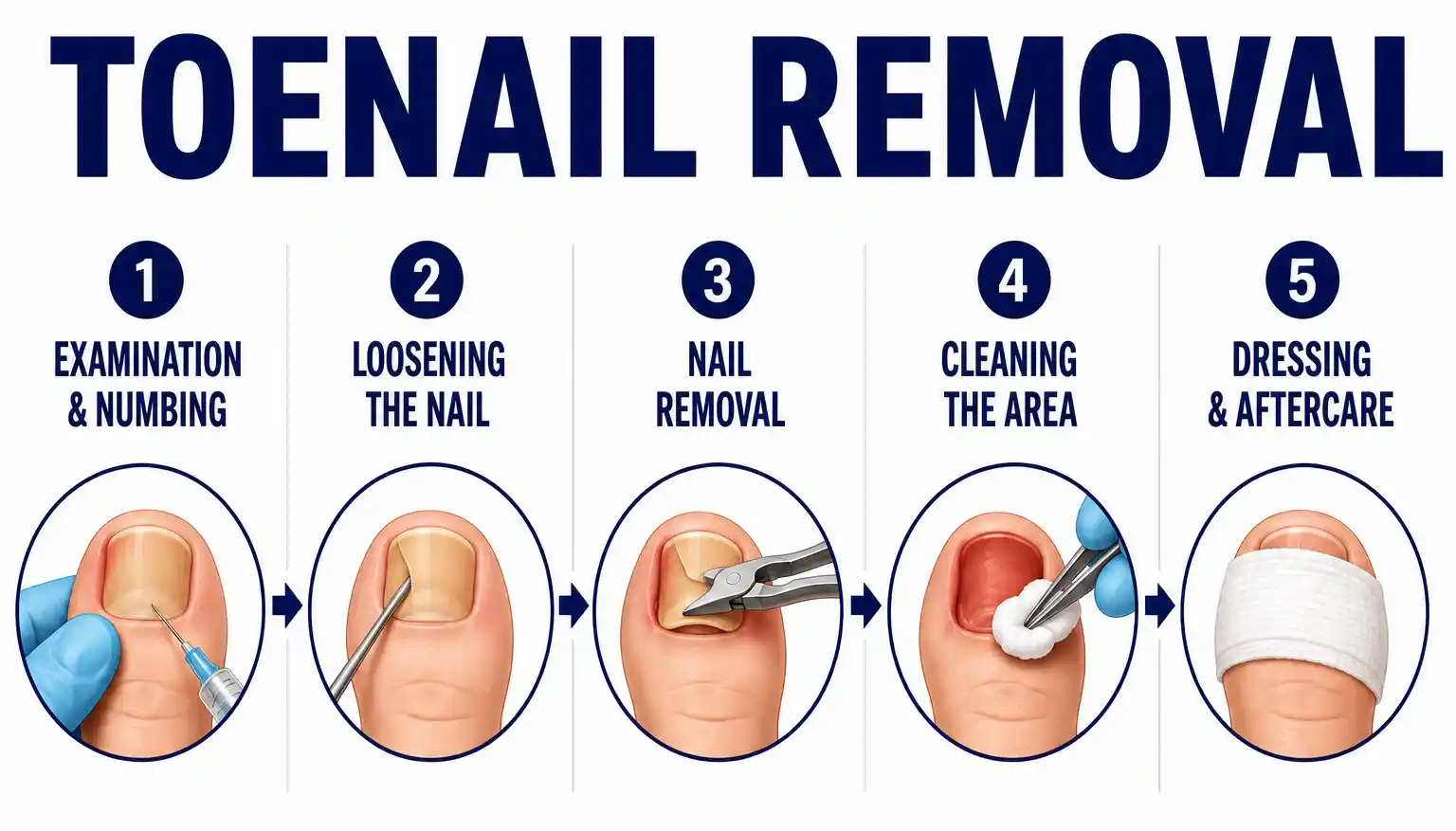 Fungal nail and foot care photo