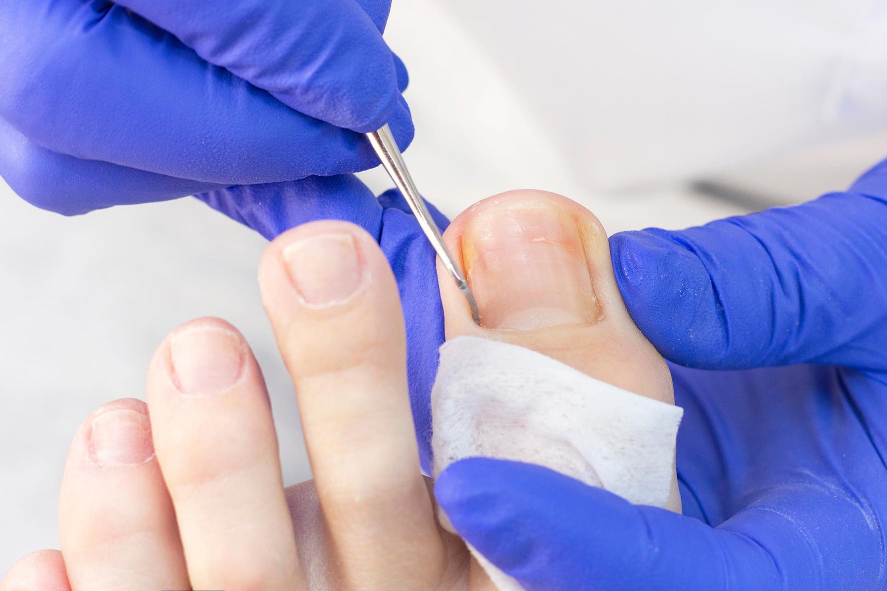 Fungal nail and foot care photo