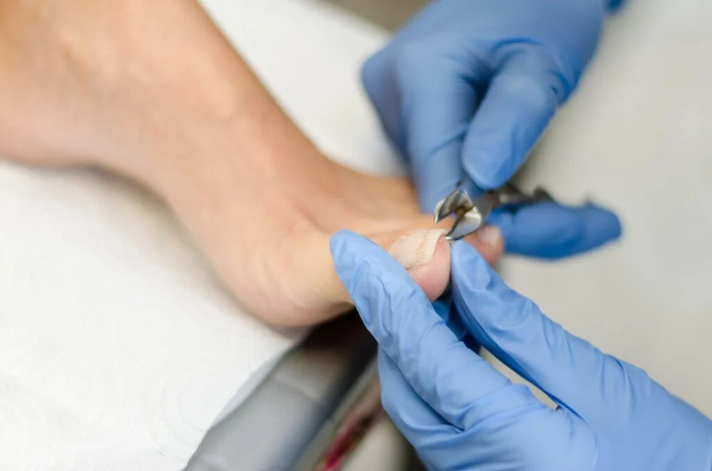 Fungal nail and foot care photo