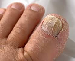 Fungal nail and foot care photo