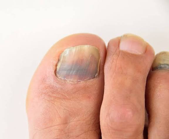 Fungal nail and foot care photo