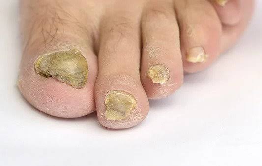 Fungal nail and foot care photo